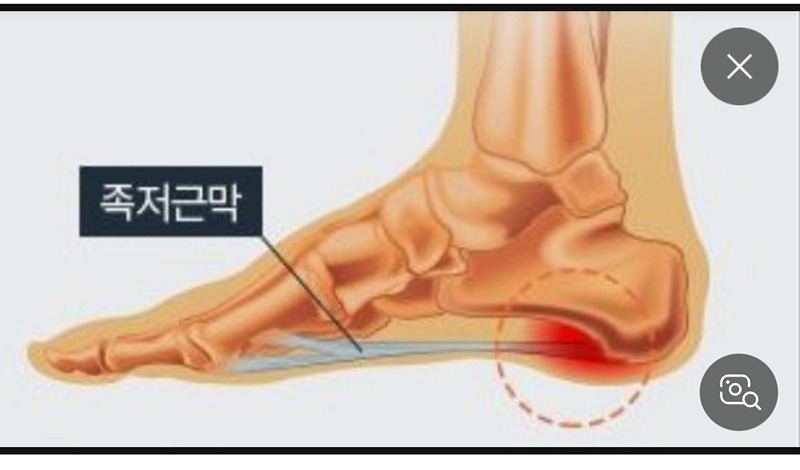 족저근막염환자분들모임 썸네일